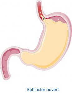 Drawing of a stomach that is experiencing acid reflux.