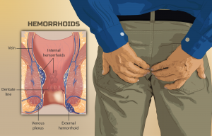 Patient suffering from piles hemorrhoids.
