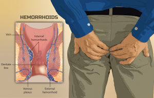 Paciente que sufre de pilas de hemorroides.