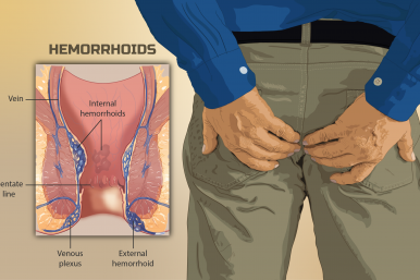 Desmitificando las hemorroides