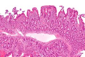 Intestinal wall suffering from celiac.